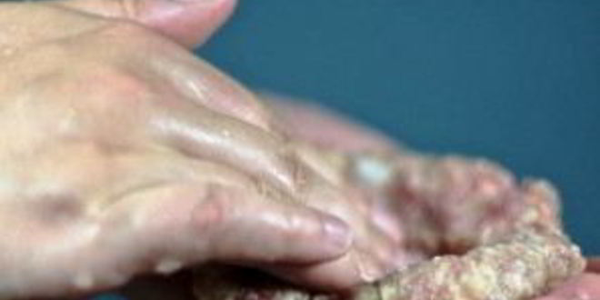 Рецепт котлет, фаршированных грибами